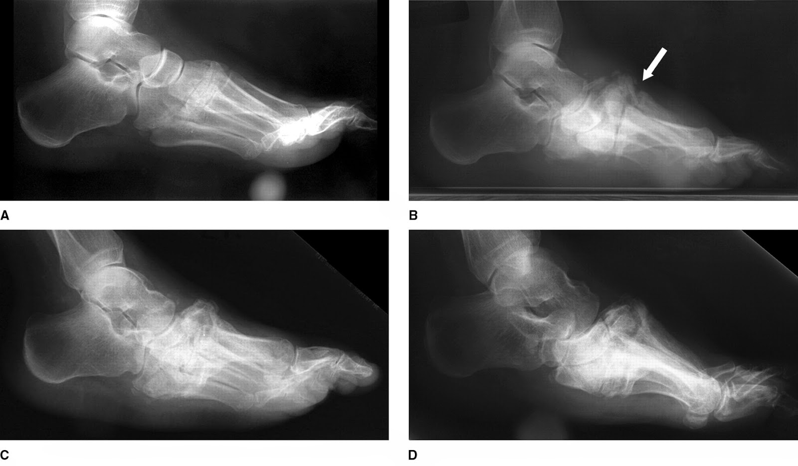 Sports Surgery Australia Charcot foot The Prevalence and the Prevention