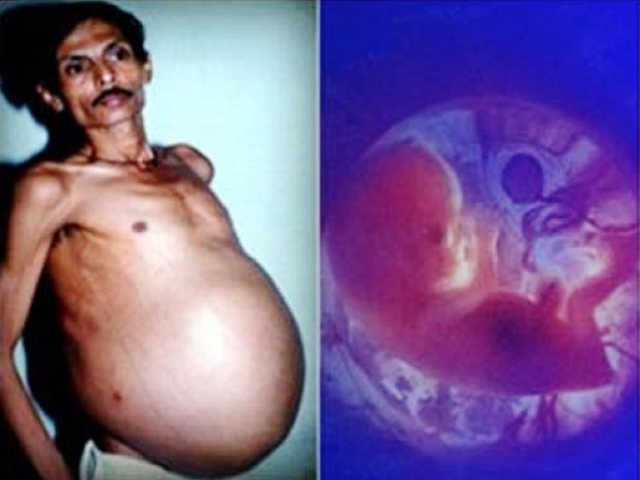 Radiografías de objetos extraños en el estómago