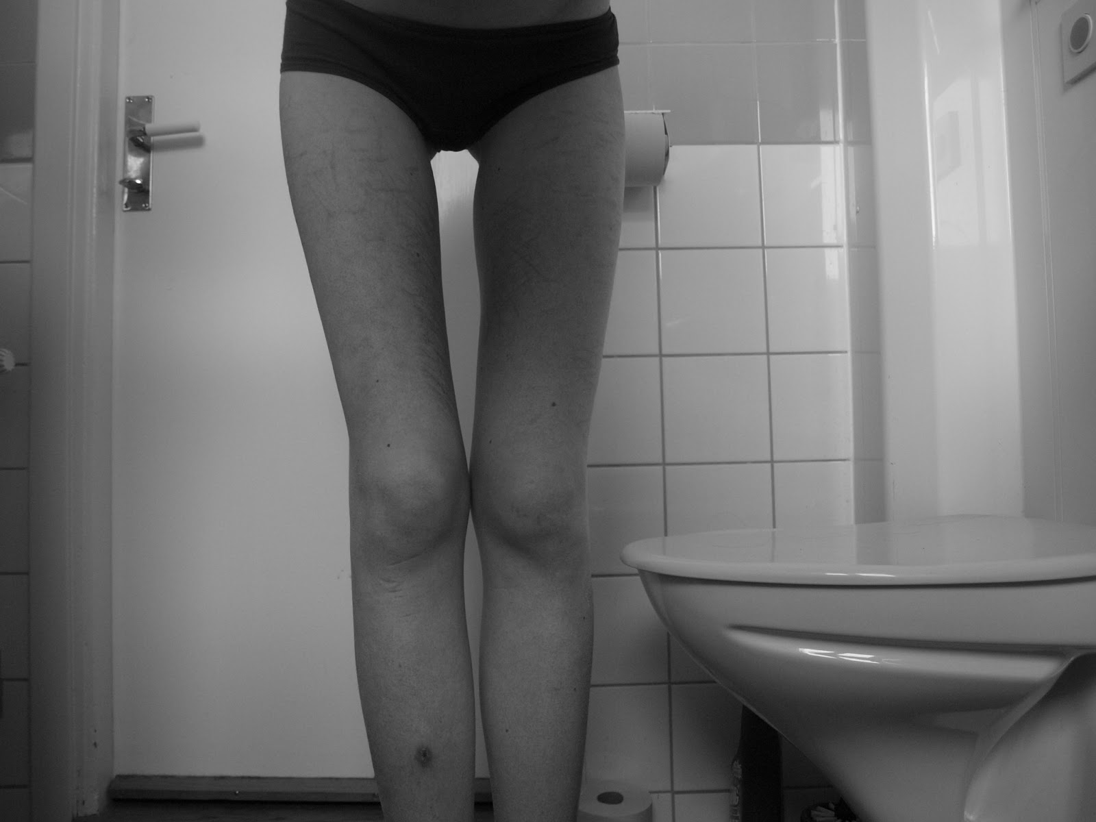 A Life Without Anorexia Love Your Legs