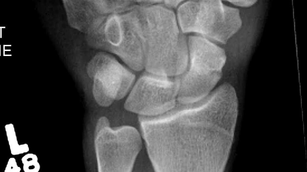 Scaphoid fracture