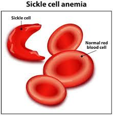 2aa Good news as first sickle cell patient gets cured with gene therapy