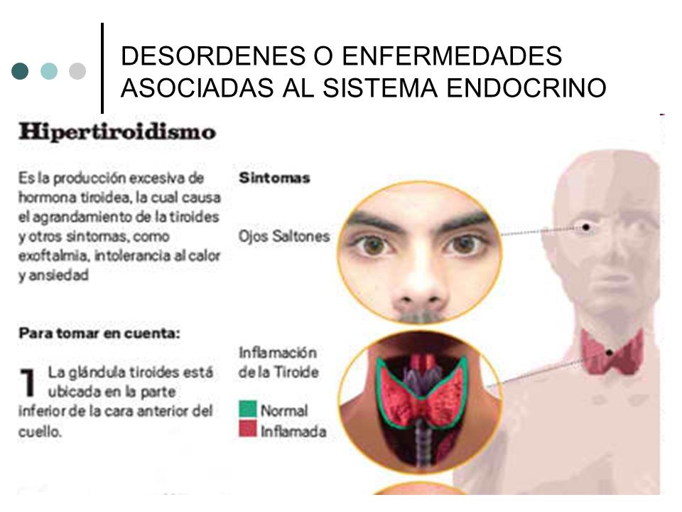 Hipertiroidismo y dolor de cabeza