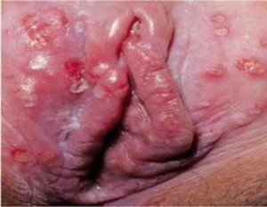 vaginal yeast infection sores Dicks sporting goods fort wayne