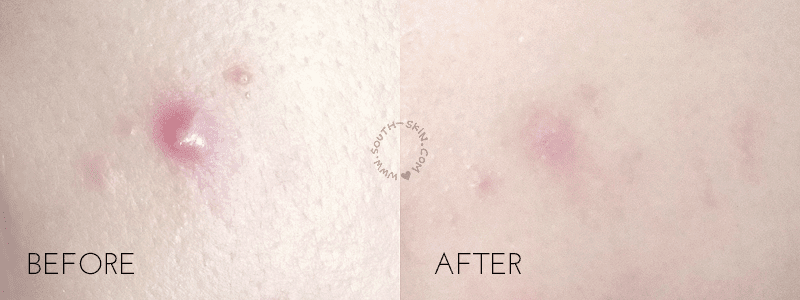 before-after-isntree-clear-skin-aha-essence-