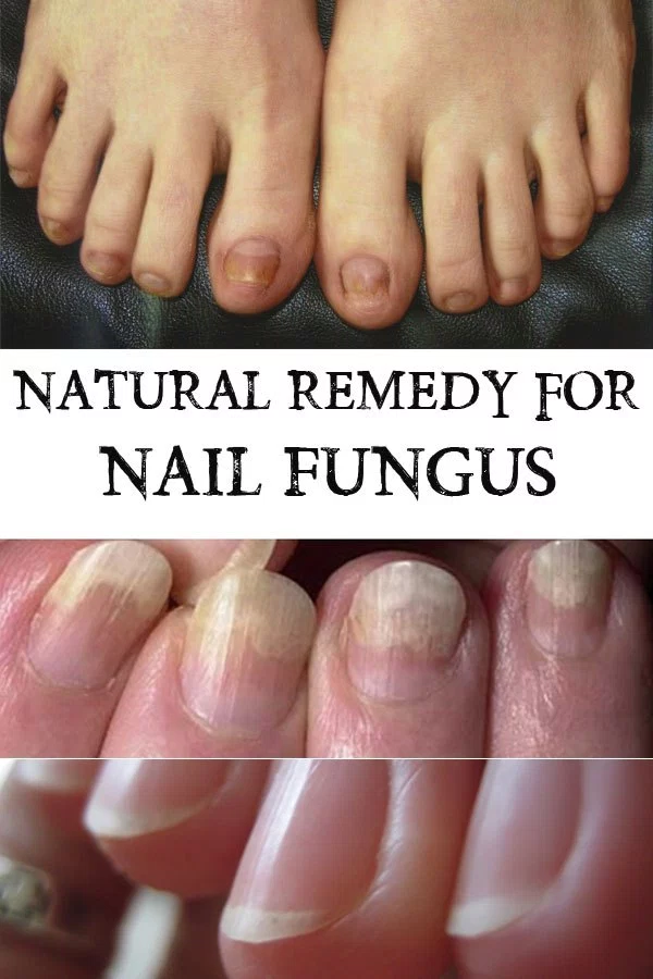 Natural Remedy for Nail Fungus HEALTHYLIFE
