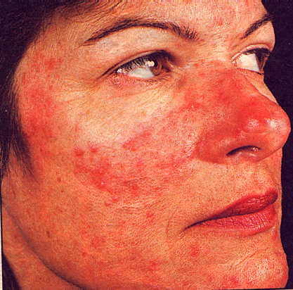 Free For Health: Acne Rosacea