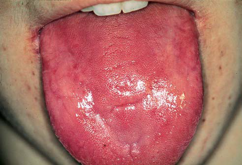 Perioral Dermatitis: Solutions for Red Bumps Around the ...