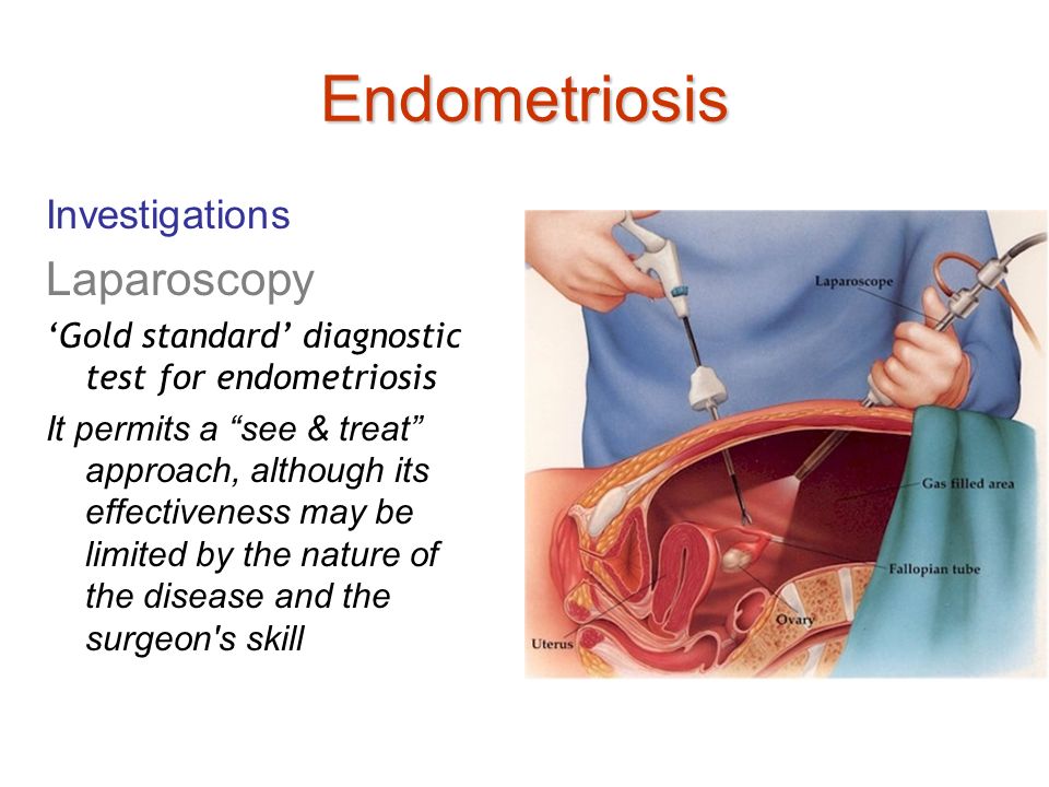 Endometriosis y cansancio