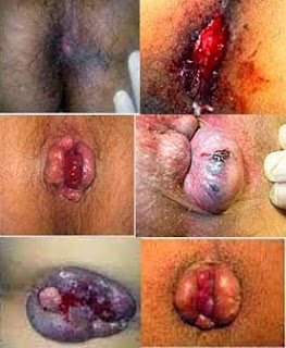 Foto Klinik Wasir Safute Di Semarang
