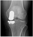 makoplasty knee
