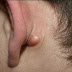 Do You Have It: This Ridge Behind The Ear Is A Sign Of Something Dangerous! Here’s What It Is…
