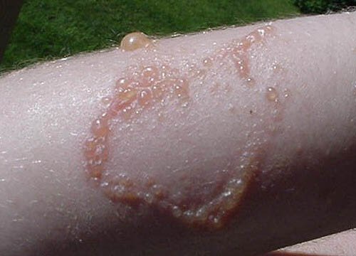 How to Get Rid of Poison Ivy Rashes (with Pictures) - wikiHow