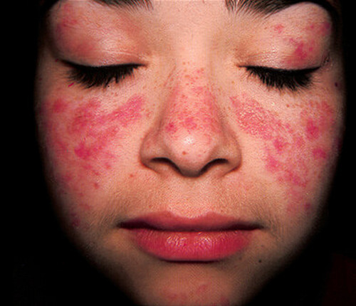 All 100+ Images photos of lupus rash on face Updated