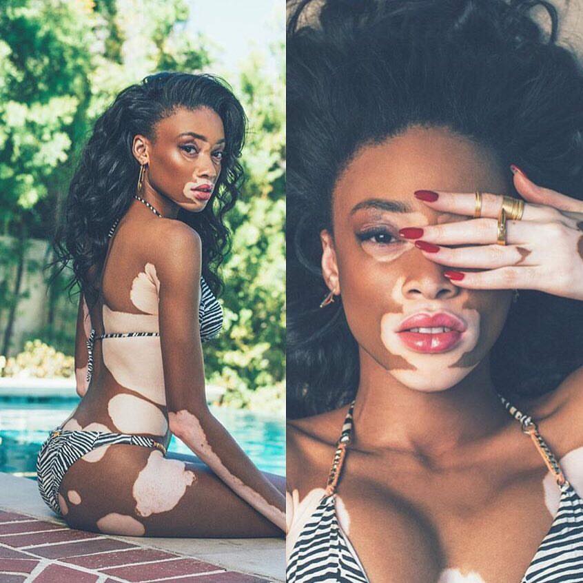 Meet chantelle brown thee model with thee rare skin type desease called vit...