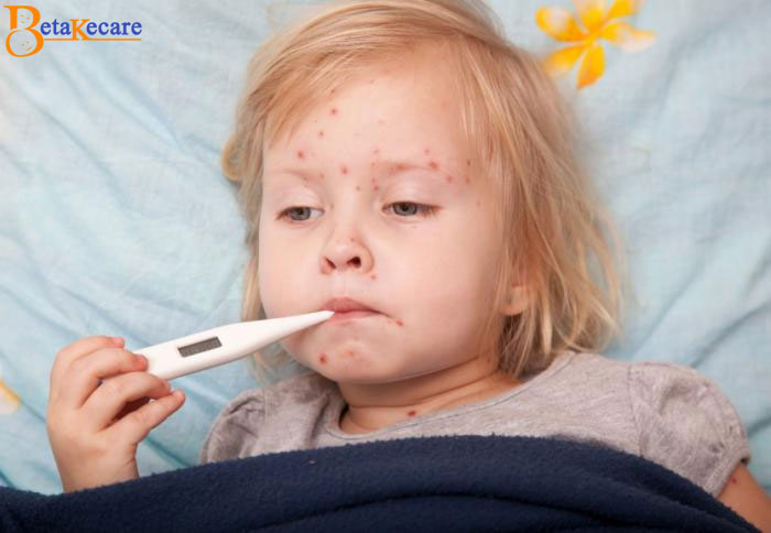 How to Help a Child with Chickenpox How to Help a Child with Chickenpox