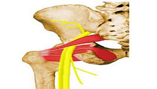sindrome+do+pir+1.jpg