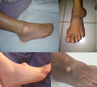 Cara Mengobati Benjolan Di Kaki Kanan dan Kiri Secara Alami Sampai Tuntas Cara Mengobati Benjolan Di Kaki Kanan dan Kiri Secara Alami Sampai Tuntas