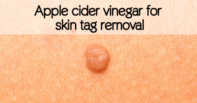 Wart Removal Natural Method Wart Removal Natural Method