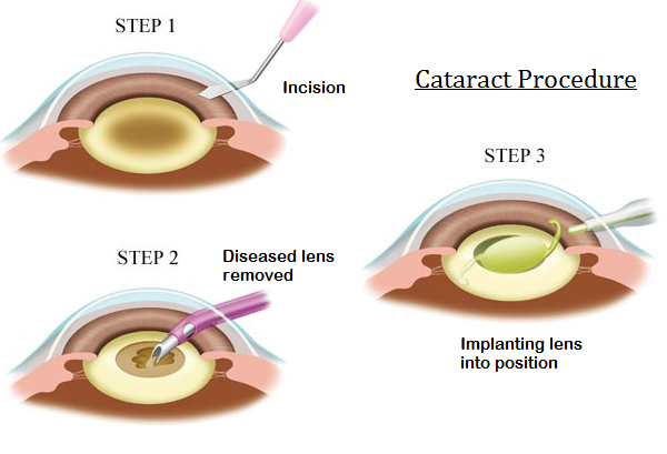 Удаление катаракты clinicaspectr ru. Факоэмульсификация катаракты с имплантацией ИОЛ этапы. Искусственный хрусталик. Искусственный хрусталик глаза. Схема факоэмульсификации.
