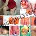 BAB atau Berak Menetes Darah Segar thumbnail