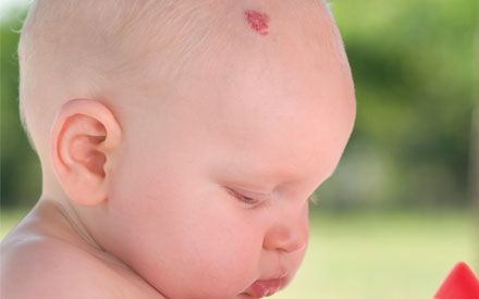 Here's the fascinating science behind why birthmarks exist