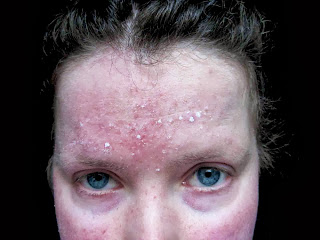 ketoconazole cream rosacea