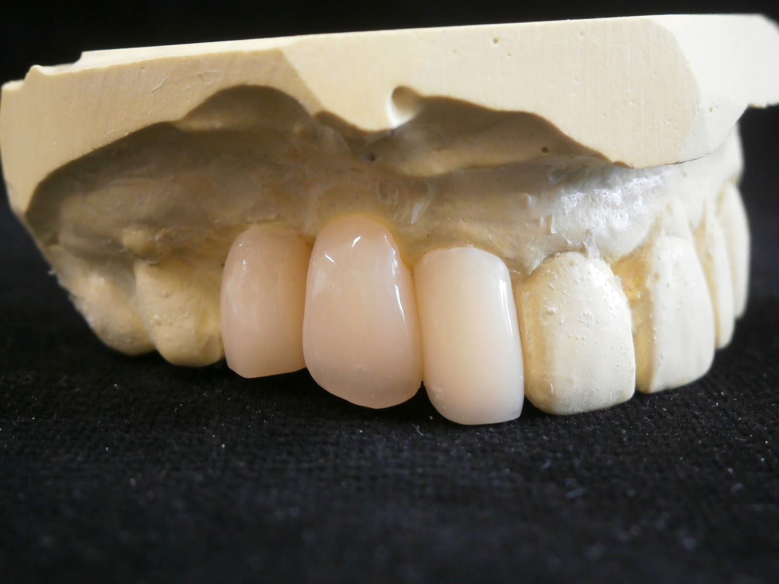 髙田朝（Hajime Takada）のオーダーメイド歯科技工物の紹介 Introduction of custommade dental