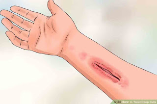 Benefits of Soursop leaves to Cure Wounds Benefits of Soursop leaves to Cure Wounds