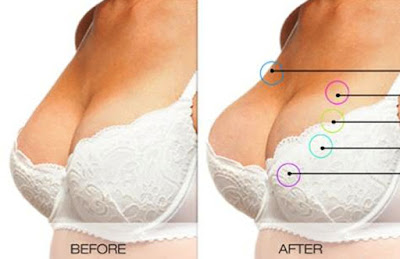 Before dan after pemakaian Vienna Breast Cream