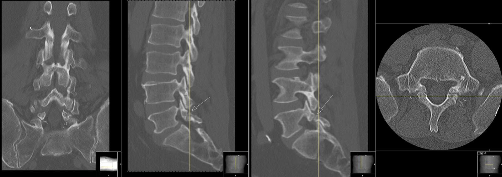 компрессионный перелом с4 с5. спондилолиз l5 позвонка рентген. оскольчатый перелом позвоночника рентген. компрессионный перелом l1 позвонка 1 степени. компрессионный перелом т12 позвонка позвоночника.