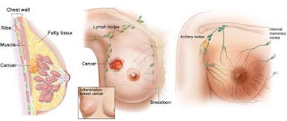 Fibroadenoma Mammae/tumor-jinak