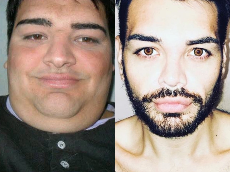 Así quedó tras operarse para parecerse a Ricky Martin Fran Mariano Ricky Martin