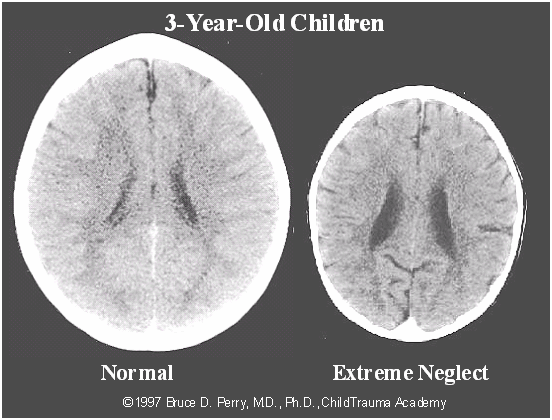 Porównanie rozwoju mózgu trzylatka rozwijającego się normalnie i dziecka w tym samym wieku z sierocińca z deficytami uwagi mu poświęconej.