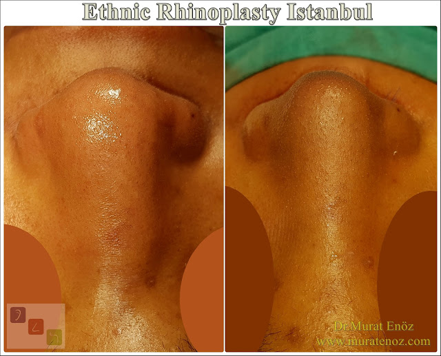 Ethnic Rhinoplasty Istanbul – Dr.Murat Enoz – Nose job in Istanbul – Nose surgery in Istanbul – Nose job in Turkey - Ethnic rhinoplasty Turkey - Ethnic rhinoplasty in Turkey - African American rhinoplasty - Ethnic expert nose job surgeon - Rhinoplasty surgeon in Istanbul - Black nose job - Rhinoplasty for ethnic nose - Rhinoplasty for African people - African American nose surgery – Rhinoplasty for African American Nose - Thick skin rhinoplasty - Rhinoplasty in istanbul Ethnic Rhinoplasty Istanbul – Dr.Murat Enoz – Nose job in Istanbul – Nose surgery in Istanbul – Nose job in Turkey - Ethnic rhinoplasty Turkey - Ethnic rhinoplasty in Turkey - African American rhinoplasty - Ethnic expert nose job surgeon - Rhinoplasty surgeon in Istanbul - Black nose job - Rhinoplasty for ethnic nose - Rhinoplasty for African people - African American nose surgery – Rhinoplasty for African American Nose - Thick skin rhinoplasty - Rhinoplasty in istanbul