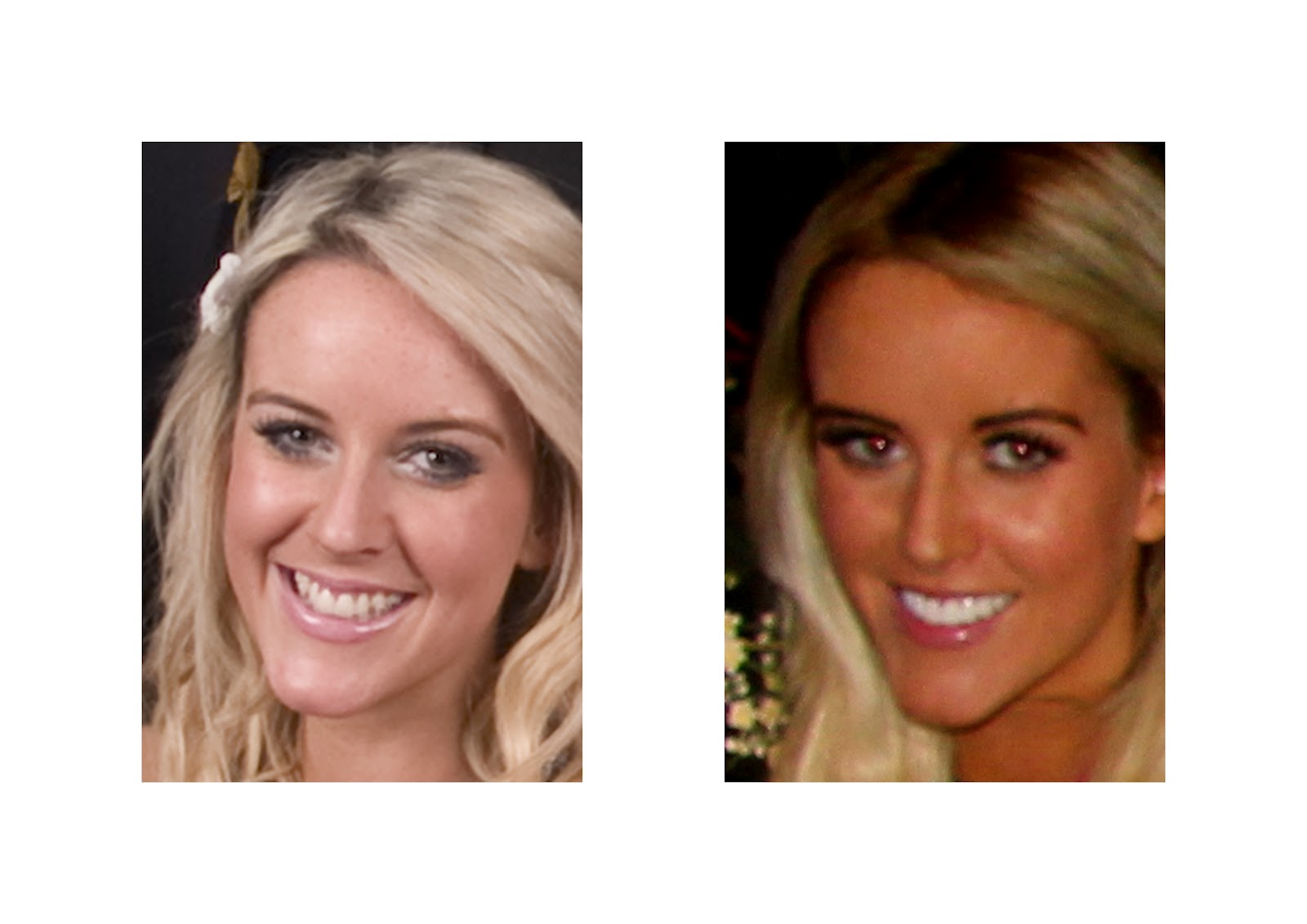 Before And After Braces Buck Teeth Before And After Braces Pictures