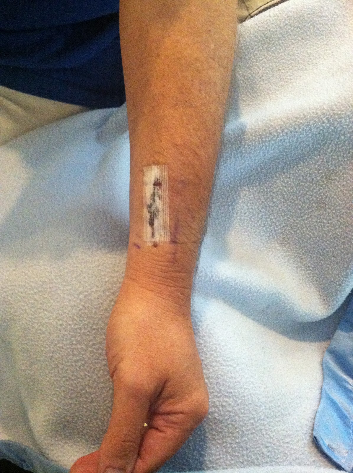 Dialysis Arm Fistula Surgery