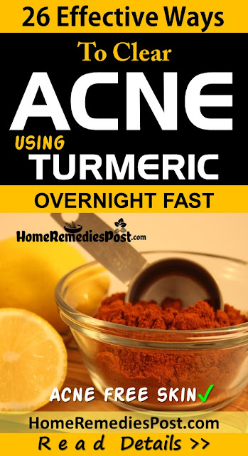 26 Ways To Use Turmeric For Acne Treatment Overnight Fast Turmeric For Acne, Turmeric Acne, Turmeric And Acne, Is Turmeric Good For Acne, How To Use Turmeric For Acne, How To Get Rid Of Acne, How To Get Rid Of Acne Fast, Home Remedies For Acne, Acne Treatment,