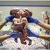 After Two Years In Hospital, Doctors Finally Share Good News For Conjoined Twins