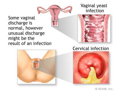 Vaginal Discharge Problem Solved 100 By Home Remedies Womens