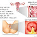 Vaginal Discharge Problem Solved 100% by Home Remedies ( Womens Sexual Parts Knowledge )