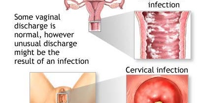 Vaginal Discharge Problem Solved 100% by Home Remedies ...