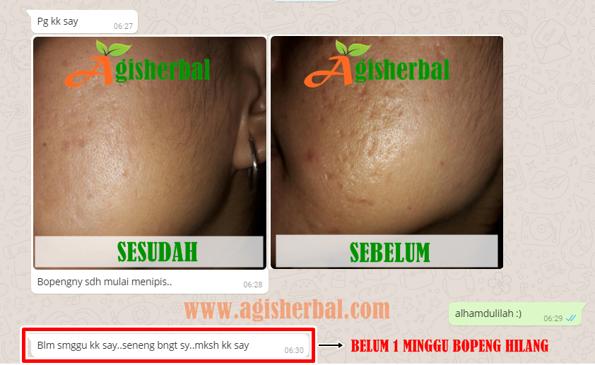 Masker QNC Jelly Gamat Untuk Bopeng Dan Jerawat