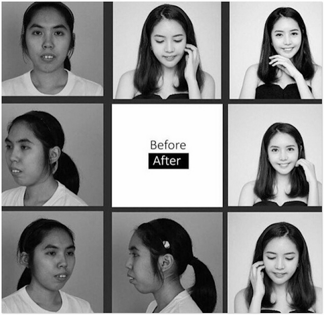 17 Foto Menakjubkan Wanita Thai Sebelum Dan Selepas Pembedahan Plastik 17 Foto Menakjubkan Wanita Thai Sebelum Dan Selepas Pembedahan Plastik