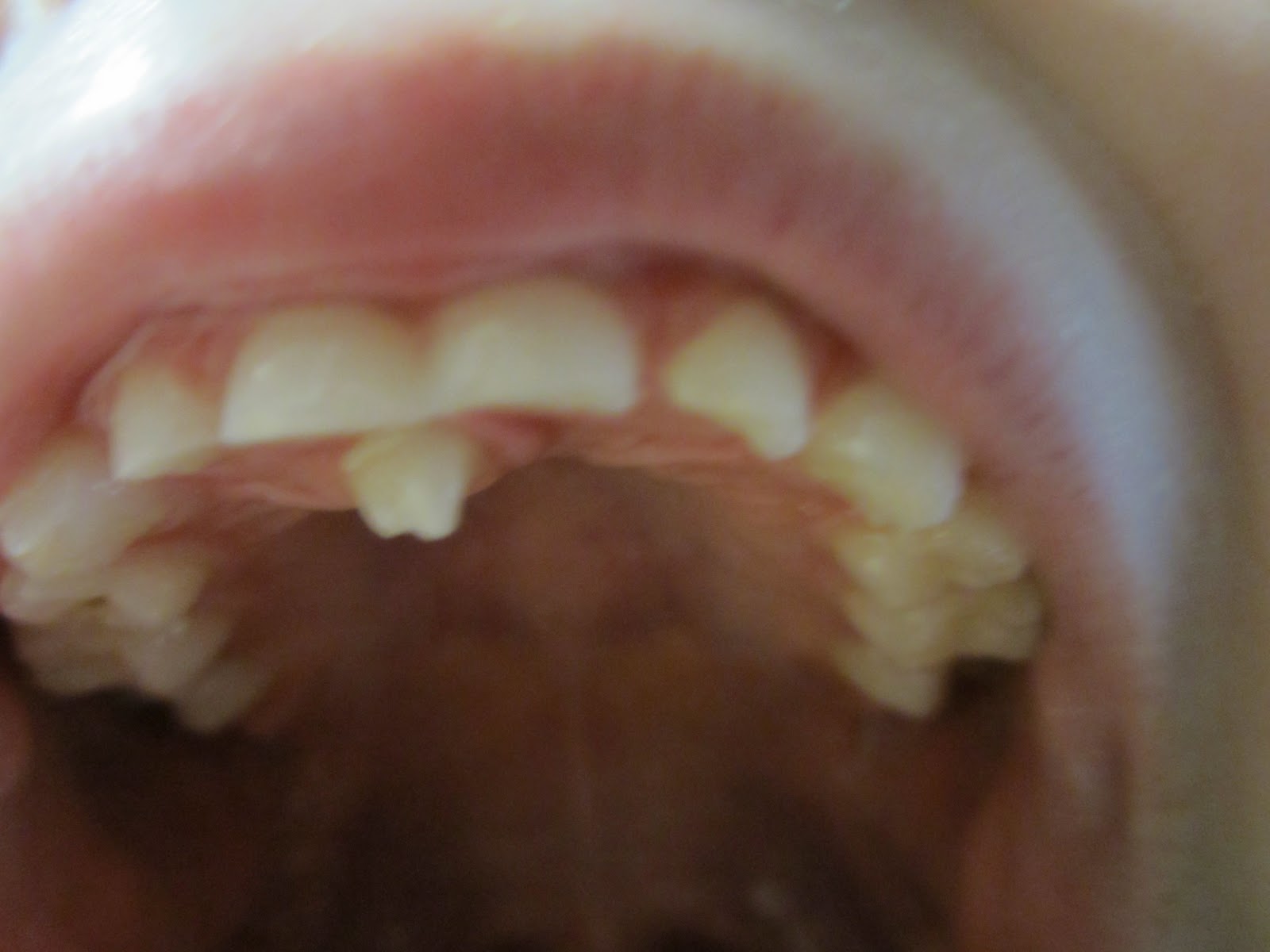 Adult Teeth Growing Behind Baby Teeth 98