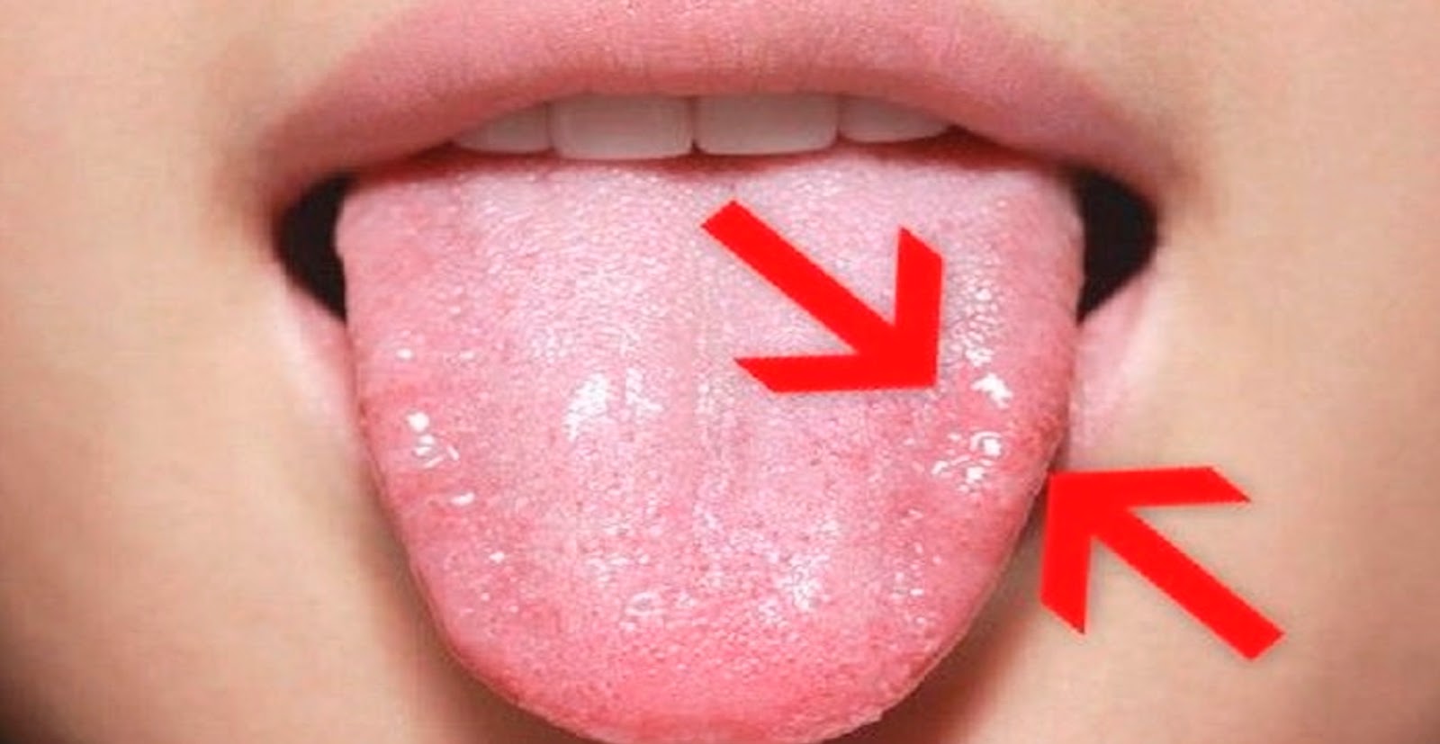 las ampollas en la lengua y boca también son conocidas como aftas o