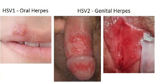 Obat Infeksi Menular Seksual Obat Infeksi Menular Seksual