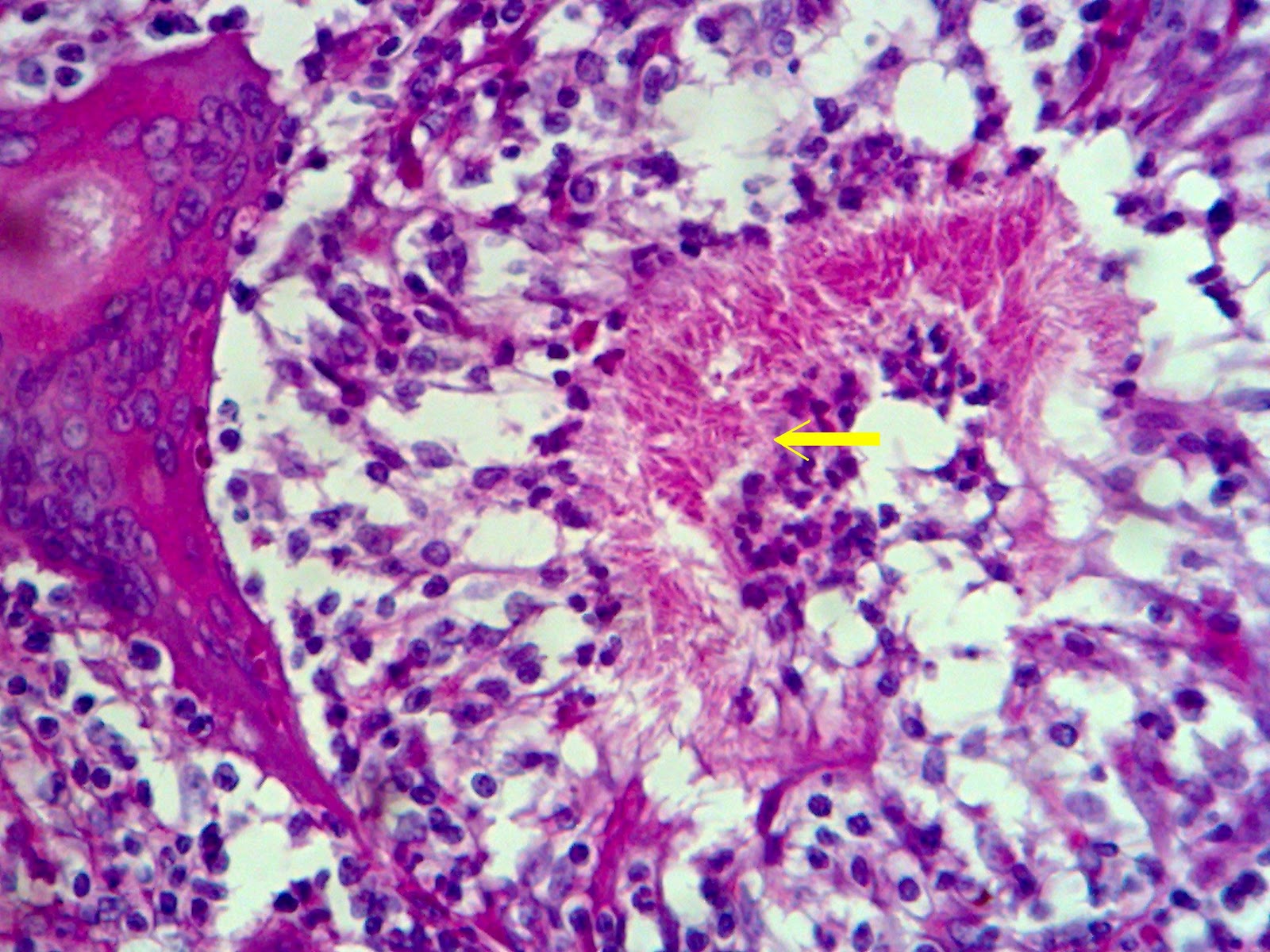 Oakley Fuel Cell Sunglasses >> HISTOPATHOLOGY: Granulomatous Mastitis (Fungal) Oakley Fuel Cell Sunglasses >> HISTOPATHOLOGY: Granulomatous Mastitis (Fungal)