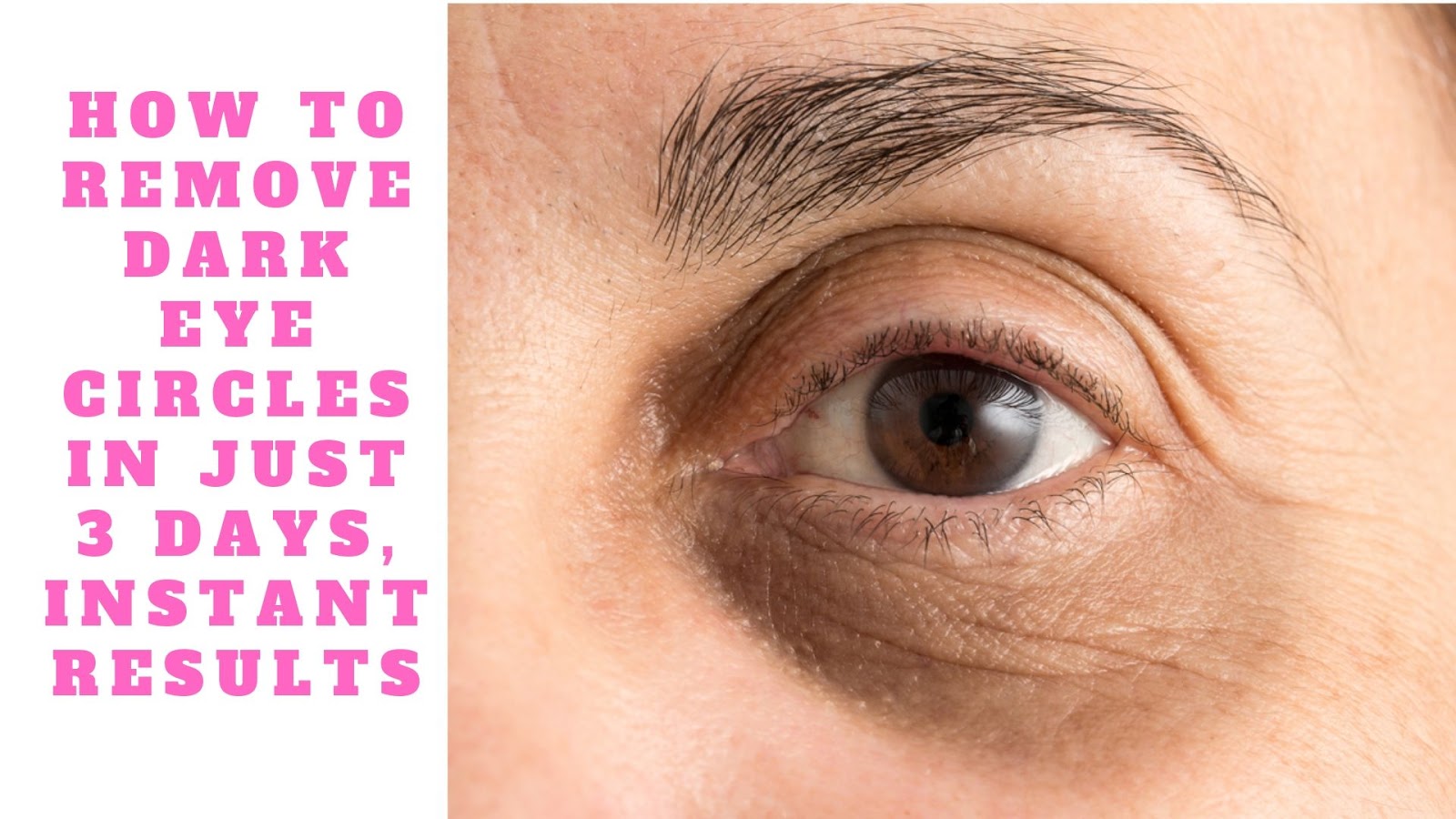 How To Remove Dark Eye Circles In Just 3 Days, Instant Results Makeup