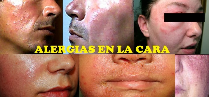 Cara alergia en granitos tratamiento la