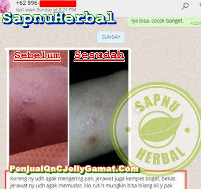 Cara Mengobati Biang Keringat di Belahan Payudara Secara Alami Cara Mengobati Biang Keringat di Belahan Payudara Secara Alami